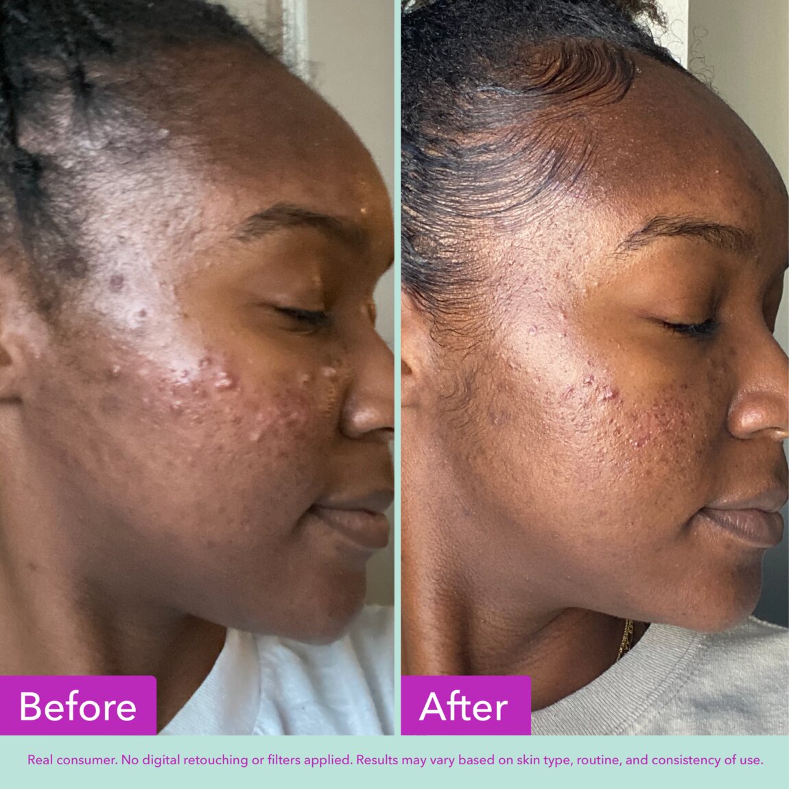 acne-foaming-cleanser-y4 zb_p.jpg